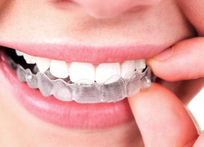 hoses à savoir sur l'orthodontie Invisalign