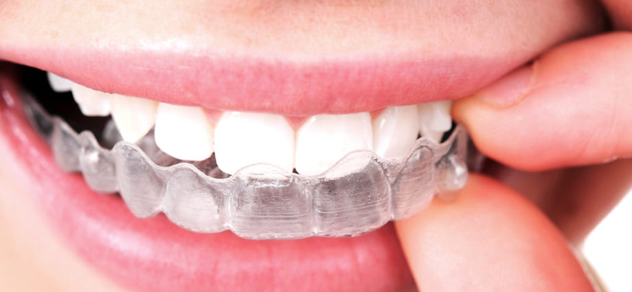 hoses à savoir sur l'orthodontie Invisalign